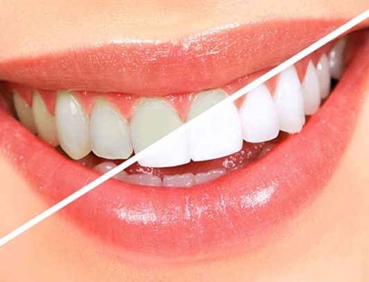 Clareamento a laser Odonto Vila Maria