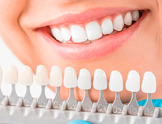 Facetas De Porcelana Odonto Vila Maria